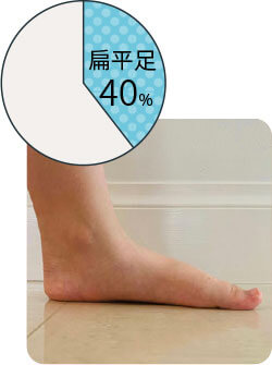 扁平足